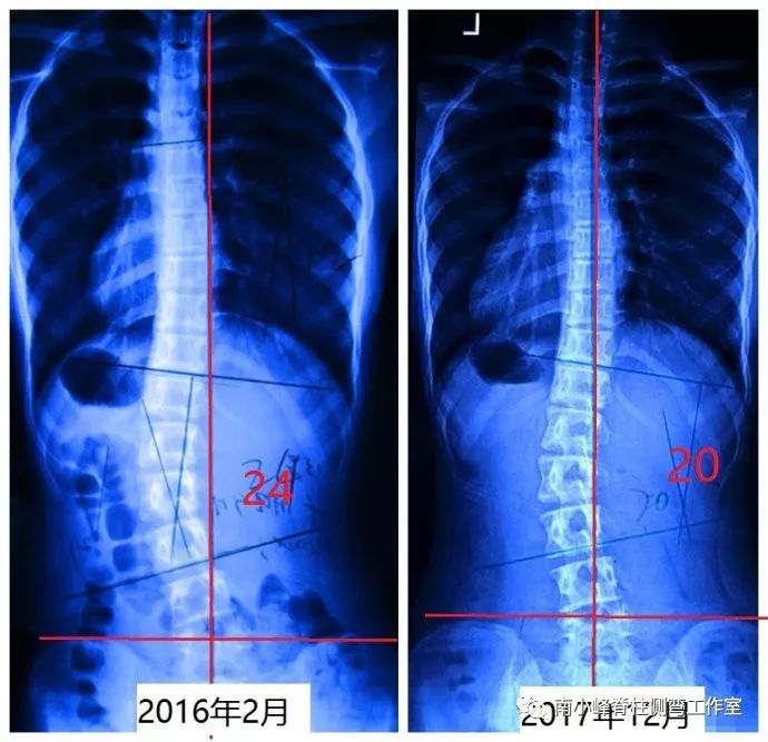 11月2日脊柱侧弯最新治疗技术,革新脊柱健康，11月最新脊柱侧弯治疗技术解析