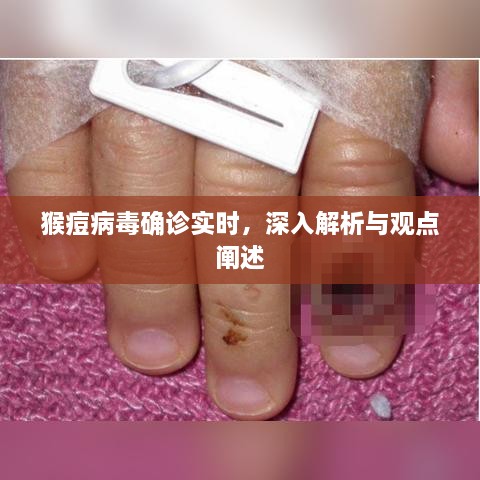 猴痘病毒确诊实时，深度解析及观点阐述